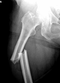 Fosamax-class-action-lawsuit-femur-fracture-side-effects-lawsuit