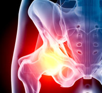 DePuy-ASR-Hip-Implant-Replacement-Recall-Lawsuit-Osteolysis-Metalosis-Cobalt-Poisoning