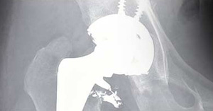 Osteolysis-Metalosis-Cobalt-Poisoning Osteolysis-Metalosis-Cobalt-Poisoning