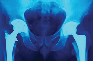 right-medical-profemur-hip-implant-replacement-failure-lawsuits