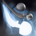 /defective-medical-devices-side-effects-lawsuits  wright-medical-profemur-hip-implant-replacement-failure-lawsuits/