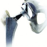 /defective-medical-devices-side-effects-lawsuits  wright-medical-profemur-hip-implant-replacement-failure-lawsuits/